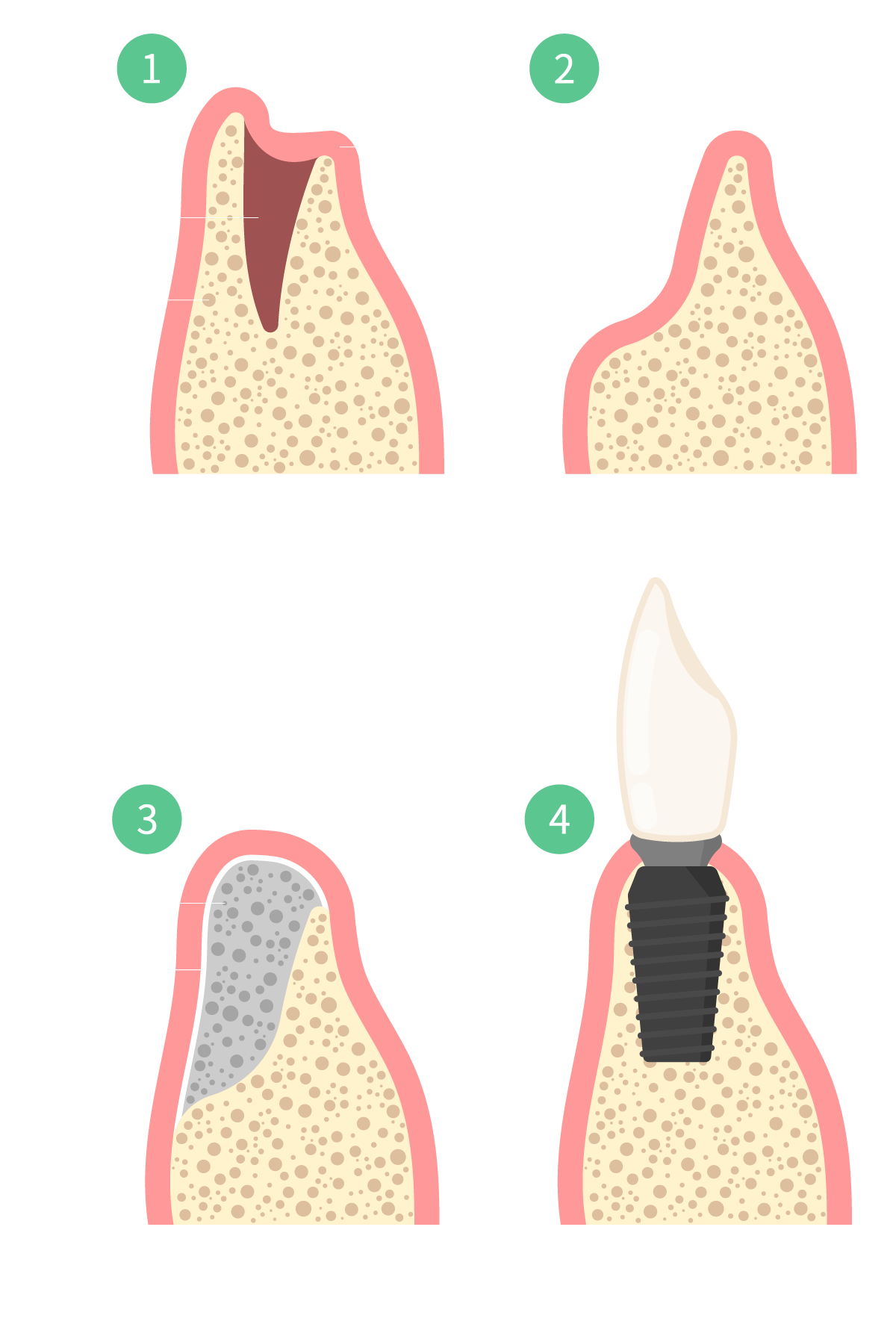 Lakewood Implant bone grafting
