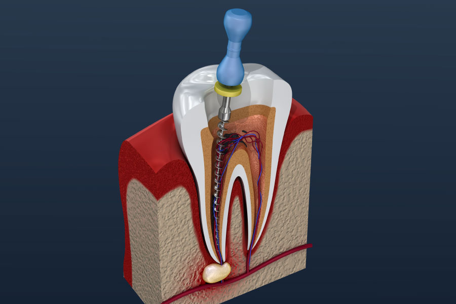 Lakewood Root Canals